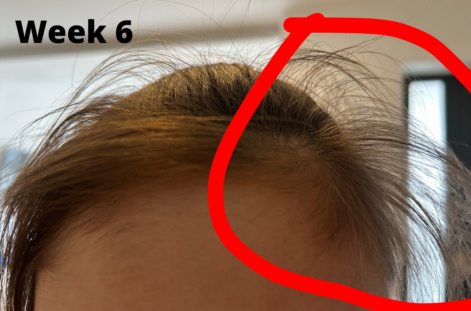 Week 6 - new growth along the hairline